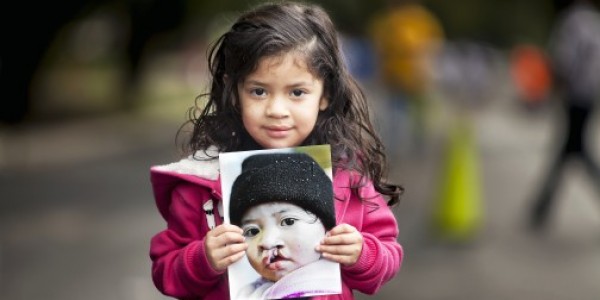 Dokter Bart Operation Smile